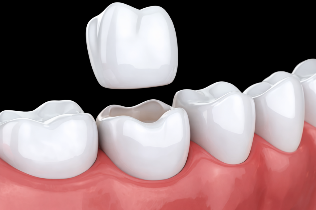 Dental Implants in Saket